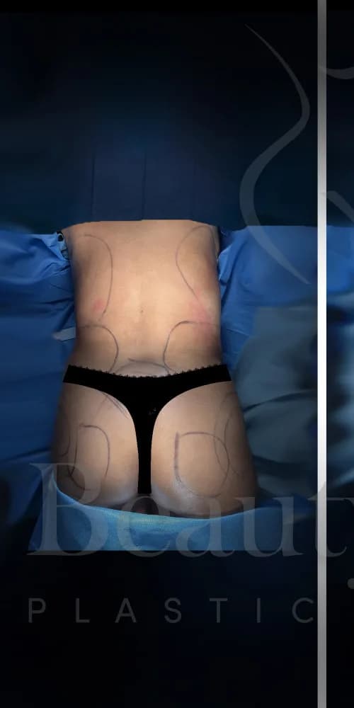 Aumento de glúteos BBL antes por Dr. Oliver Simmons en Miami · Beautyland Plastic Surgery