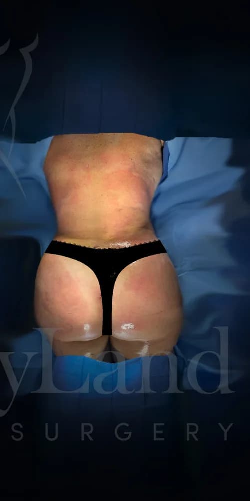 Aumento de glúteos BBL después por Dr. Oliver Simmons en Miami · Beautyland Plastic Surgery