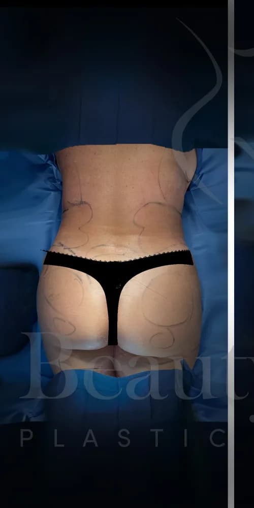 Aumento de glúteos BBL antes por Dr. Oliver Simmons en Miami · Beautyland Plastic Surgery