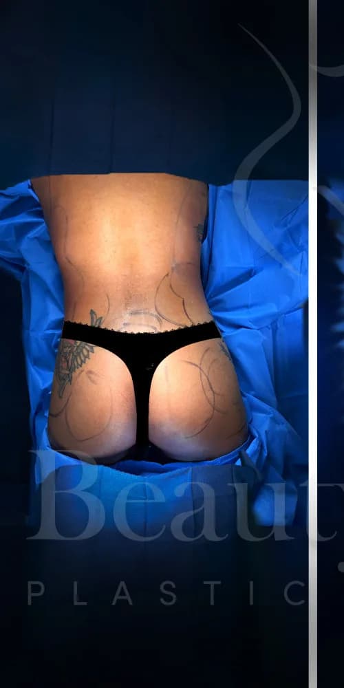 Aumento de glúteos BBL antes por Dr. Oliver Simmons en Miami · Beautyland Plastic Surgery