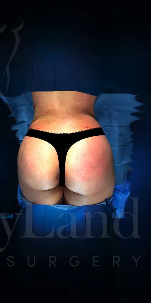 Aumento de glúteos BBL después por Dr. Oliver Simmons en Miami · Beautyland Plastic Surgery