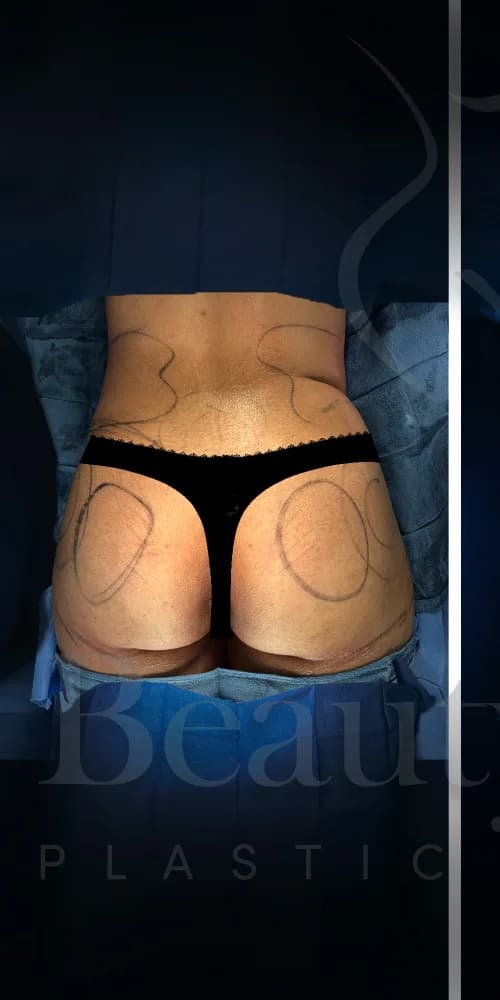 Aumento de glúteos BBL antes por Dr. Oliver Simmons en Miami · Beautyland Plastic Surgery