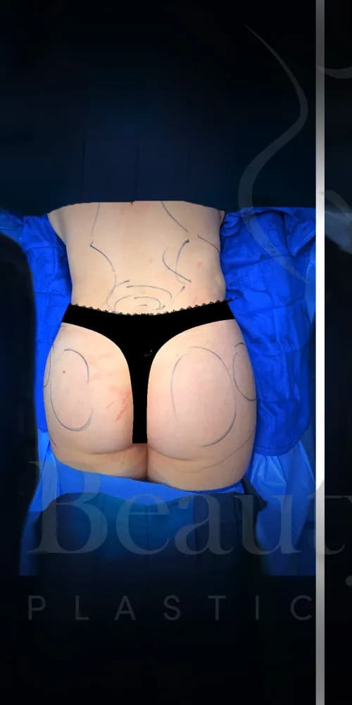 Aumento de glúteos BBL antes por Dr. Oliver Simmons en Miami · Beautyland Plastic Surgery