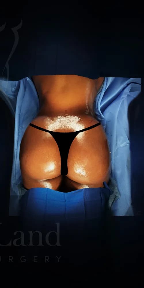 Aumento de glúteos BBL después por Dr. Oliver Simmons en Miami · Beautyland Plastic Surgery