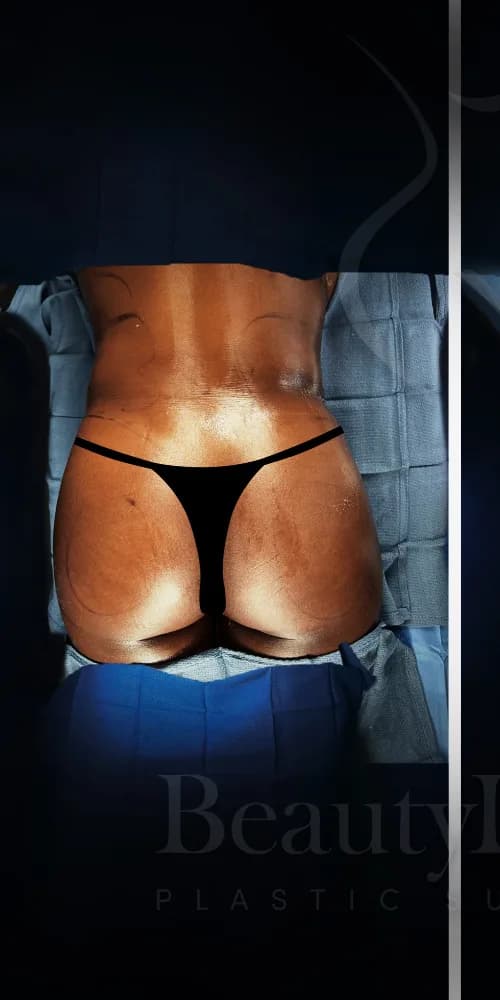 Aumento de glúteos BBL antes por Dr. Oliver Simmons en Miami · Beautyland Plastic Surgery