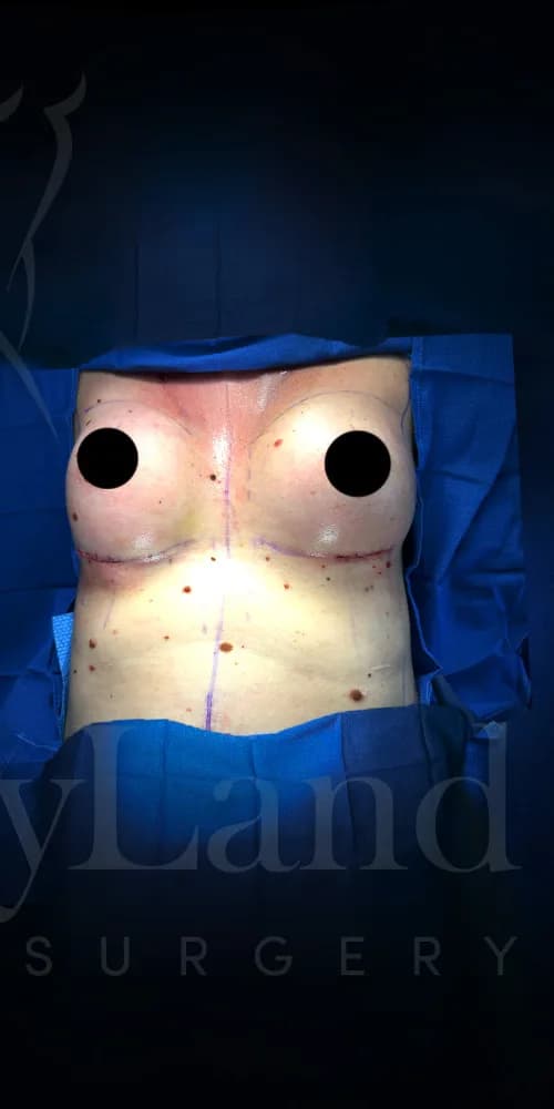 Aumento de senos después por Dr. Anne-Sophie Lessard en Miami · Beautyland Plastic Surgery