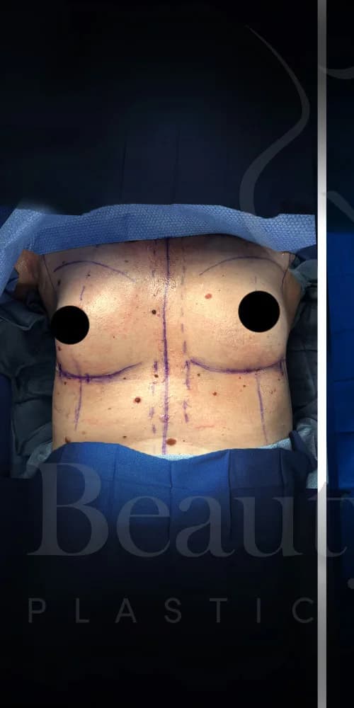 Aumento de senos antes por Dr. Anne-Sophie Lessard en Miami · Beautyland Plastic Surgery
