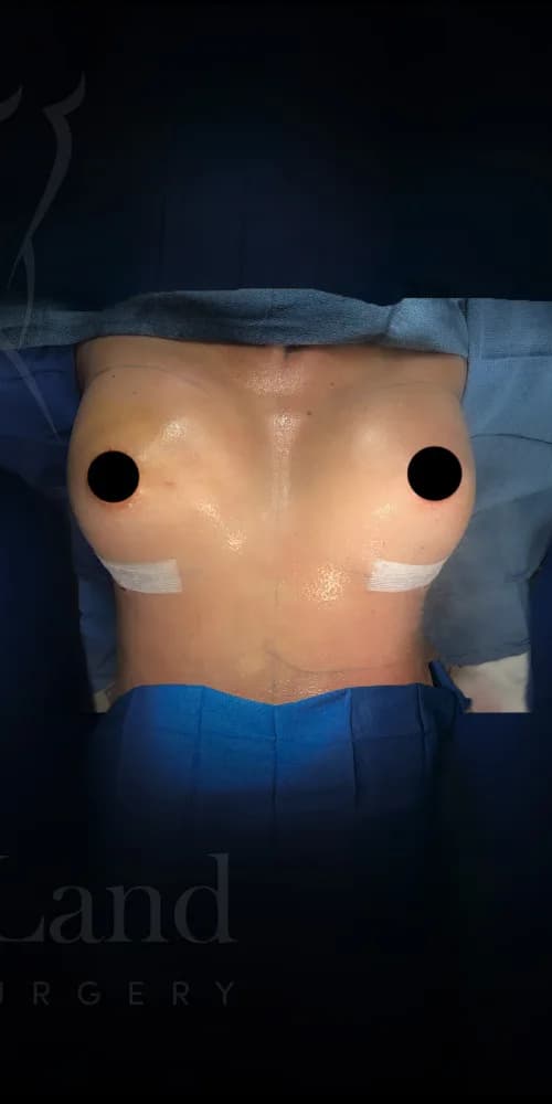 Aumento de senos después por Dr. Anne-Sophie Lessard en Miami · Beautyland Plastic Surgery