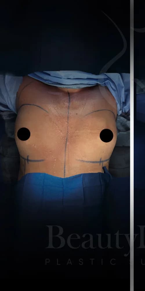 Aumento de senos antes por Dr. Anne-Sophie Lessard en Miami · Beautyland Plastic Surgery