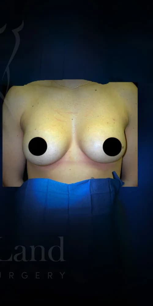 Aumento de senos después por Dr. Christopher J. Salgado en Miami · Beautyland Plastic Surgery