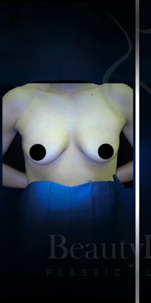 Aumento de senos antes por Dr. Christopher J. Salgado en Miami · Beautyland Plastic Surgery