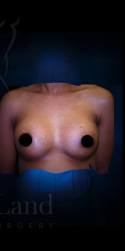 Aumento de senos después por Dr. Christopher J. Salgado en Miami · Beautyland Plastic Surgery