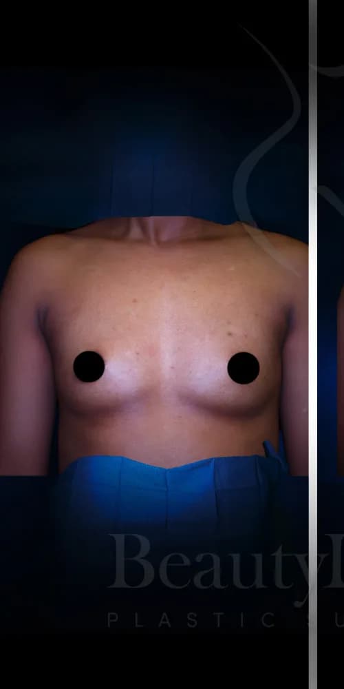 Aumento de senos antes por Dr. Christopher J. Salgado en Miami · Beautyland Plastic Surgery