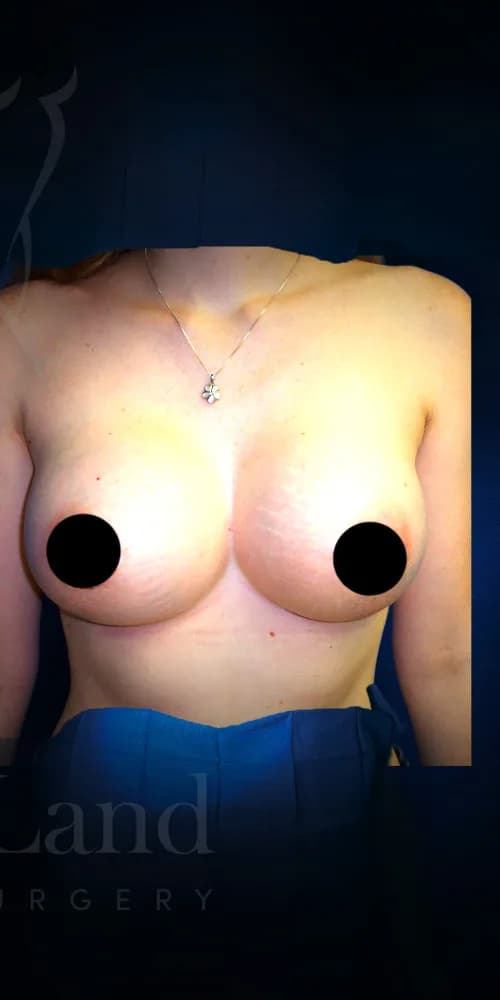 Aumento de senos después por Dr. Christopher J. Salgado en Miami · Beautyland Plastic Surgery