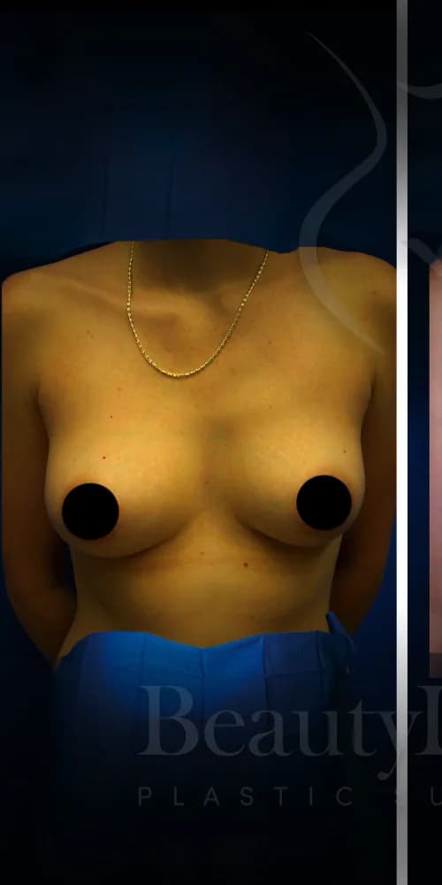 Aumento de senos antes por Dr. Christopher J. Salgado en Miami · Beautyland Plastic Surgery