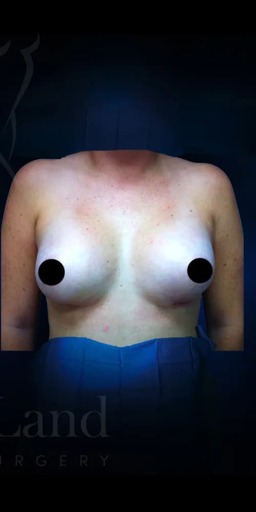 Aumento de senos después por Dr. Christopher J. Salgado en Miami · Beautyland Plastic Surgery