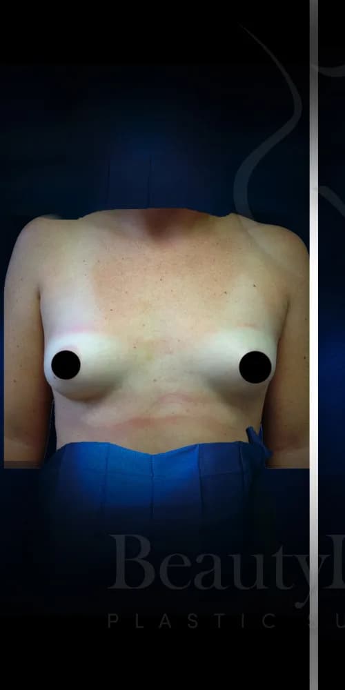 Aumento de senos antes por Dr. Christopher J. Salgado en Miami · Beautyland Plastic Surgery