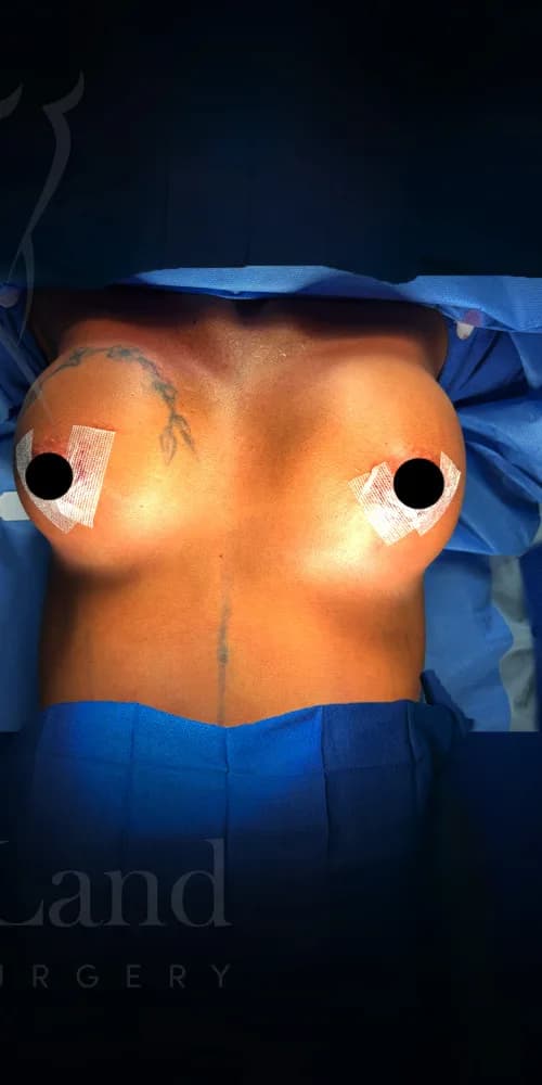 Aumento de senos después por Dr. Christopher J. Salgado en Miami · Beautyland Plastic Surgery