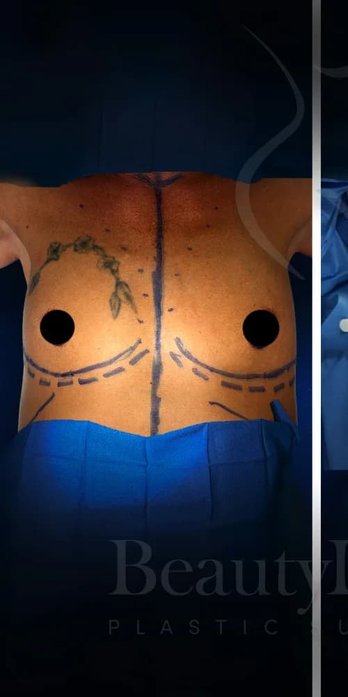 Aumento de senos antes por Dr. Christopher J. Salgado en Miami · Beautyland Plastic Surgery