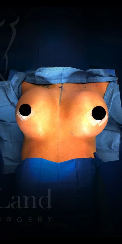 Aumento de senos después por Dr. Christopher J. Salgado en Miami · Beautyland Plastic Surgery