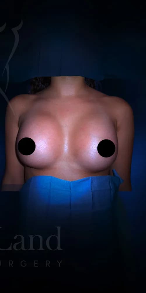 Aumento de senos después por Dr. Christopher J. Salgado en Miami · Beautyland Plastic Surgery