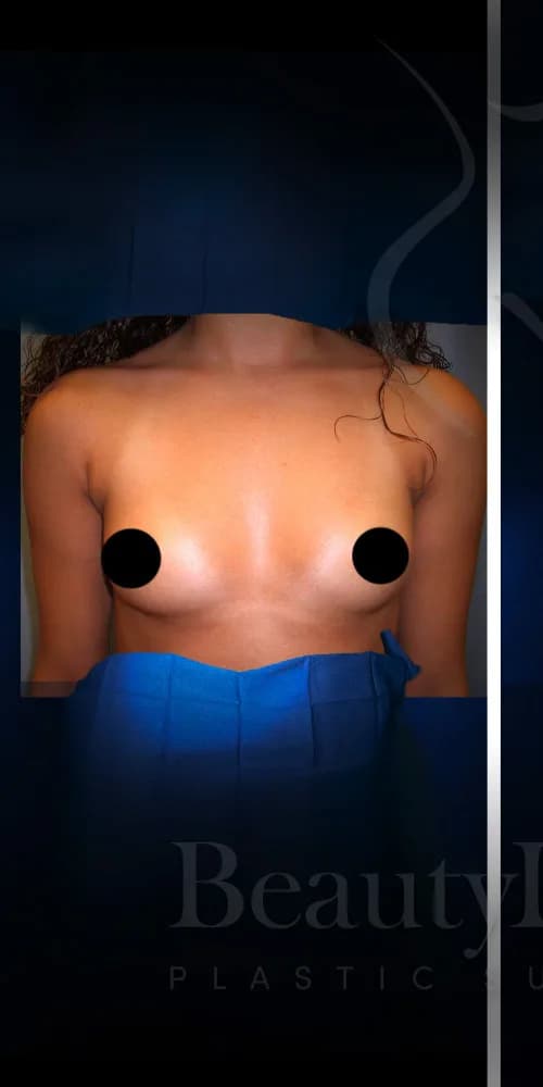 Aumento de senos antes por Dr. Christopher J. Salgado en Miami · Beautyland Plastic Surgery