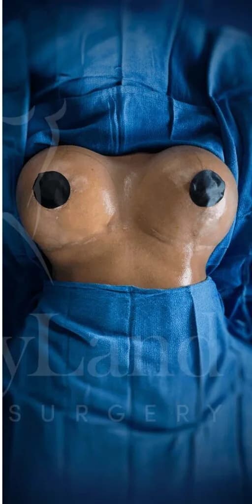 Mastopexia (elevación de senos) después por Dr. Oliver Simmons en Miami · Beautyland Plastic Surgery