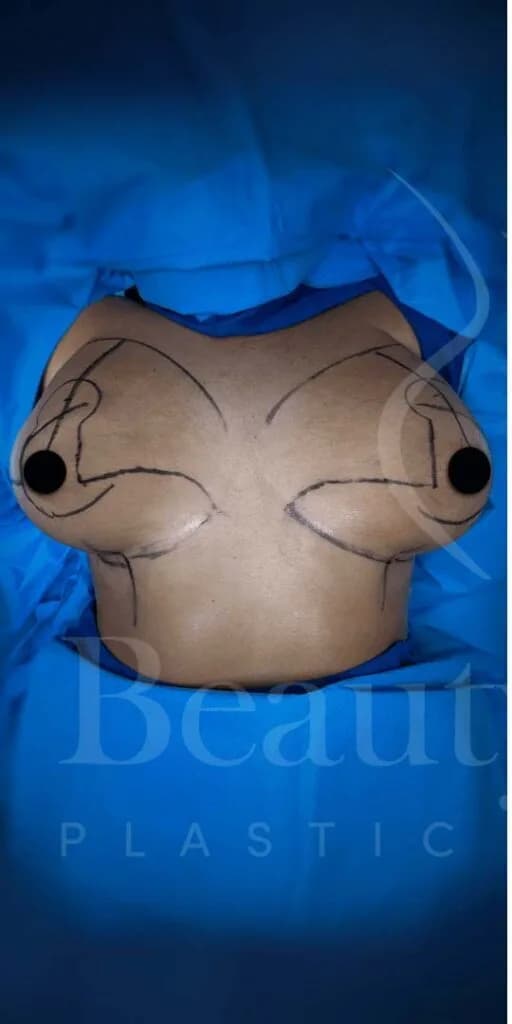 Mastopexia (elevación de senos) antes por Dr. Oliver Simmons en Miami · Beautyland Plastic Surgery
