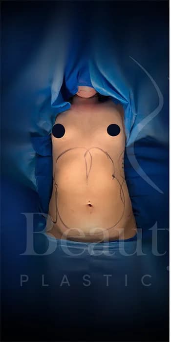 Aumento de senos antes por Dr. Oliver Simmons en Miami · Beautyland Plastic Surgery