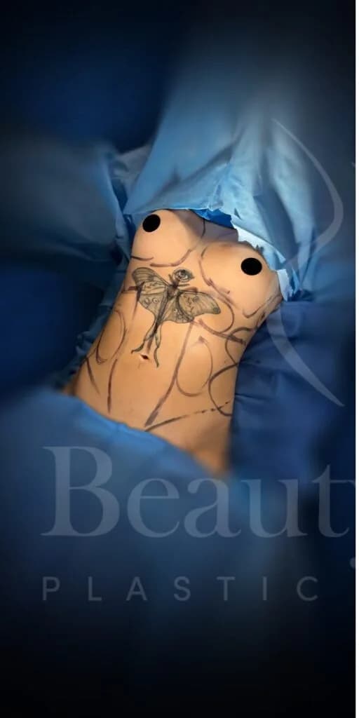 Aumento de senos antes por Dr. Oliver Simmons en Miami · Beautyland Plastic Surgery