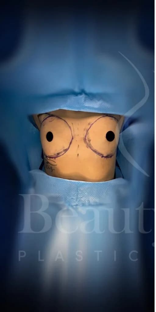 Aumento de senos antes por Dr. Oliver Simmons en Miami · Beautyland Plastic Surgery