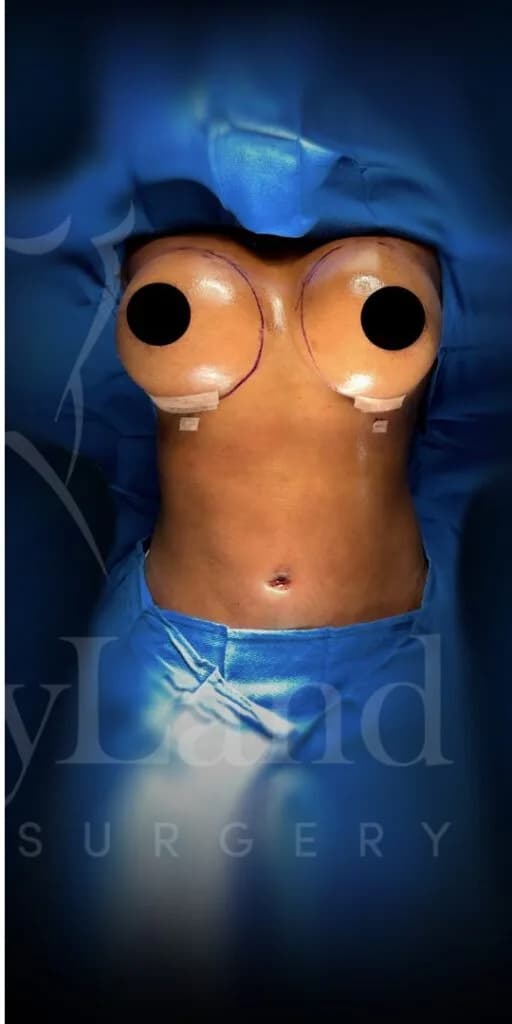Aumento de senos después por Dr. Oliver Simmons en Miami · Beautyland Plastic Surgery