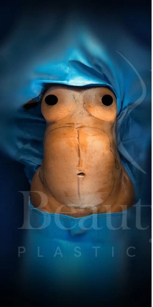 Aumento de senos antes por Dr. Oliver Simmons en Miami · Beautyland Plastic Surgery