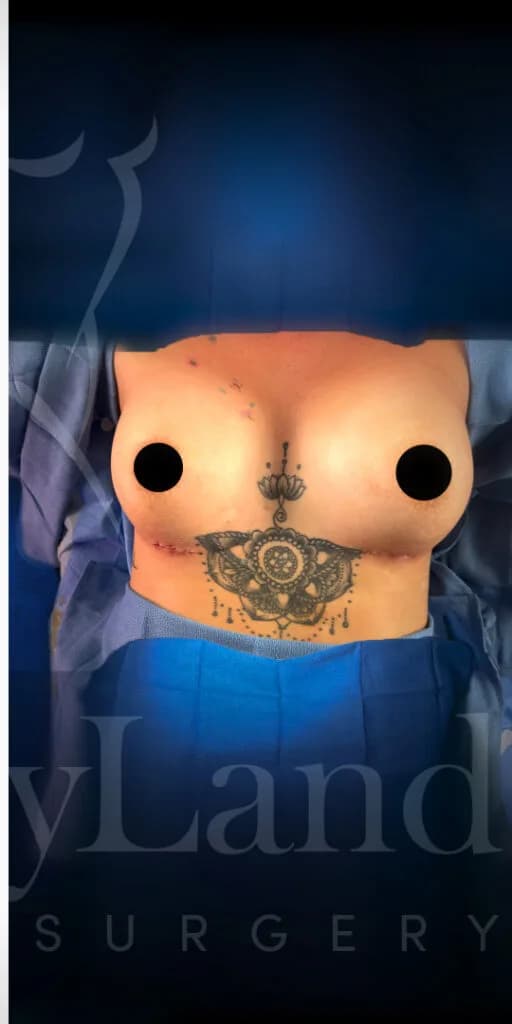 Aumento de senos después por Dr. Oliver Simmons en Miami · Beautyland Plastic Surgery
