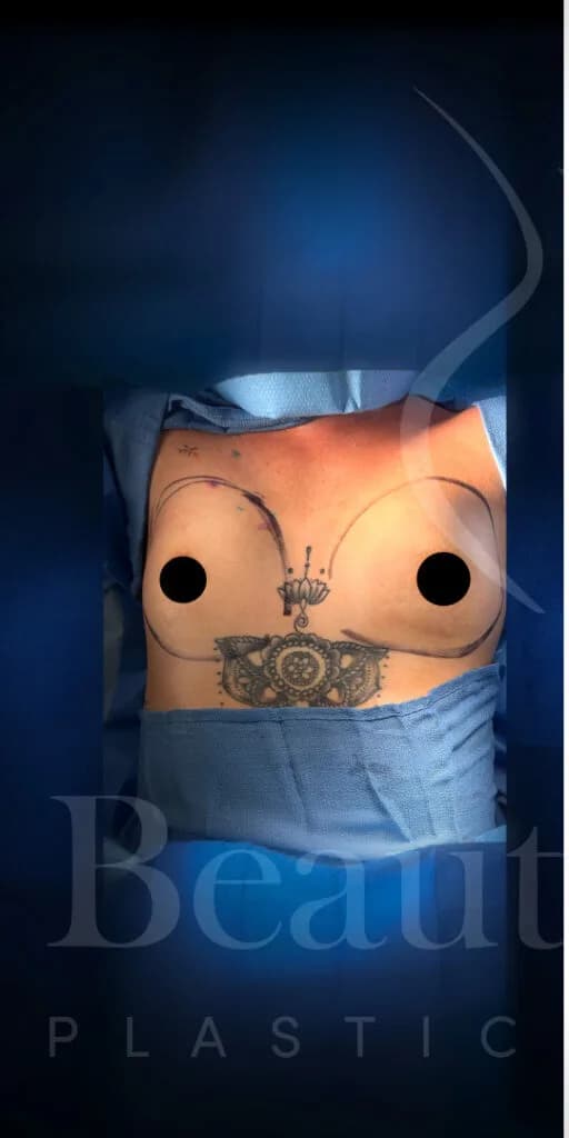 Aumento de senos antes por Dr. Oliver Simmons en Miami · Beautyland Plastic Surgery