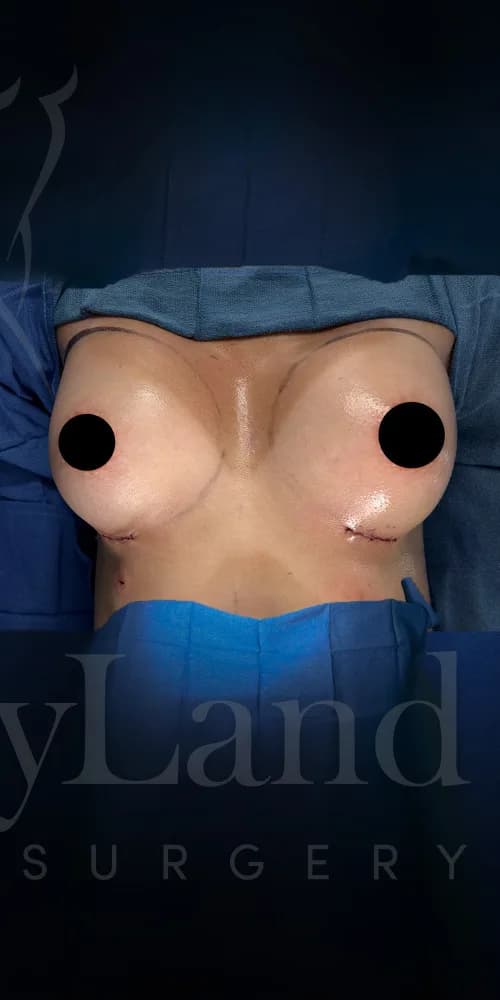 Aumento de senos después por Dr. Oliver Simmons en Miami · Beautyland Plastic Surgery