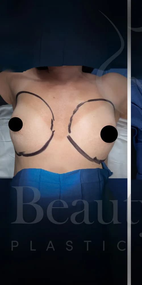 Aumento de senos antes por Dr. Oliver Simmons en Miami · Beautyland Plastic Surgery