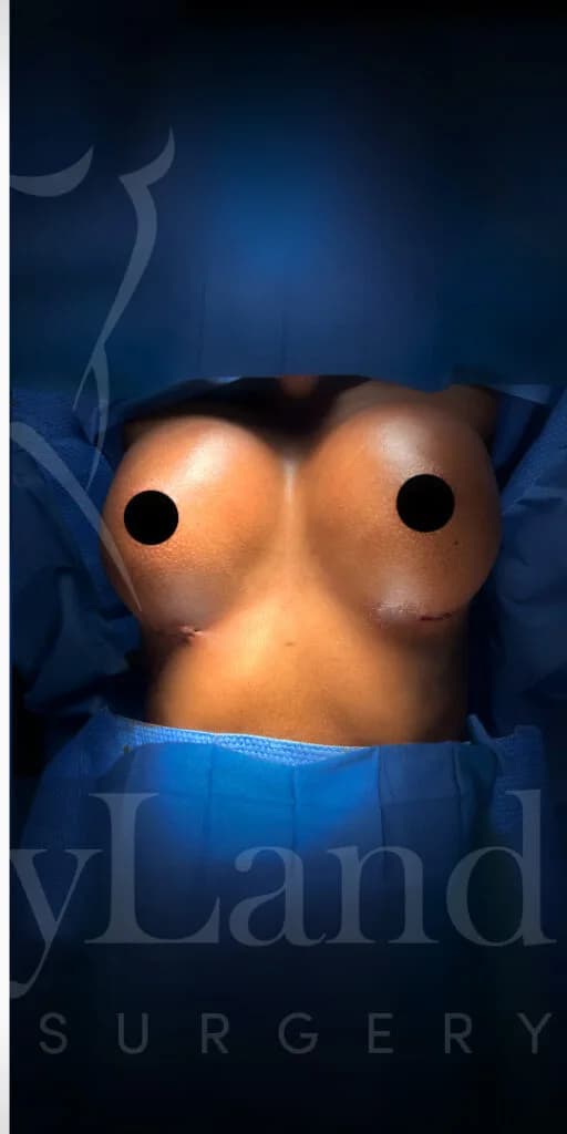 Aumento de senos después por Dr. Oliver Simmons en Miami · Beautyland Plastic Surgery