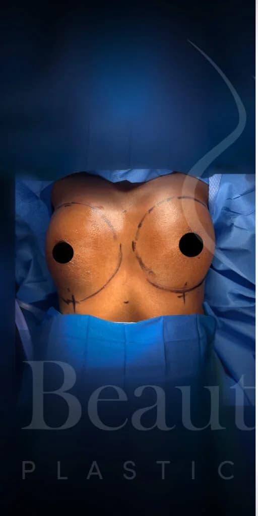 Aumento de senos antes por Dr. Oliver Simmons en Miami · Beautyland Plastic Surgery