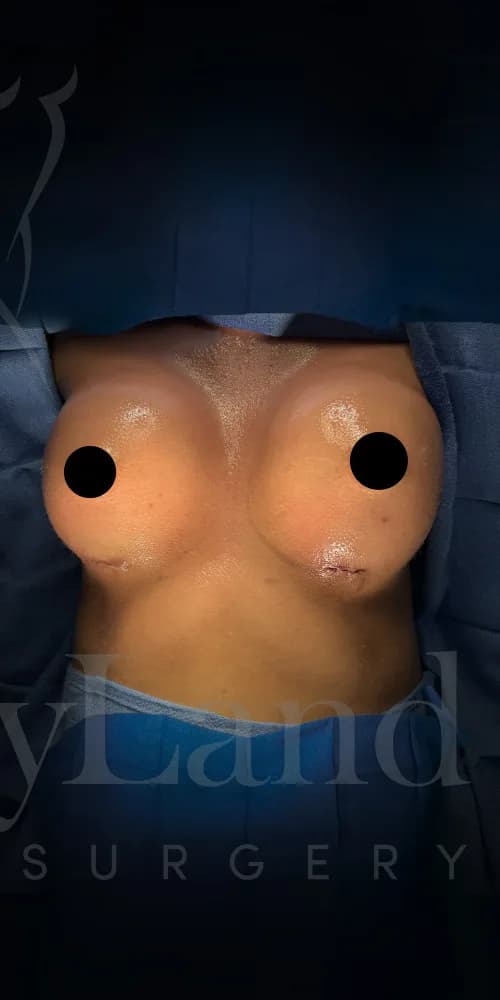 Aumento de senos después por Dr. Oliver Simmons en Miami · Beautyland Plastic Surgery