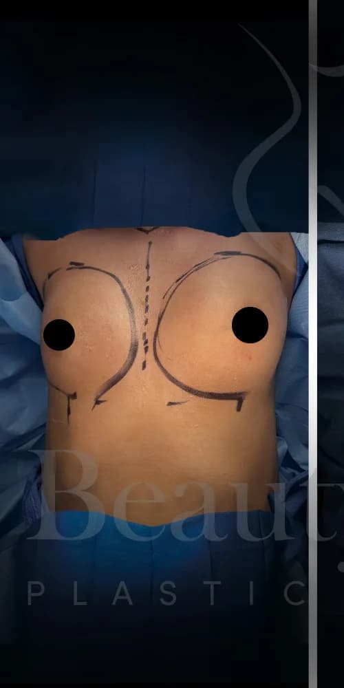 Aumento de senos antes por Dr. Oliver Simmons en Miami · Beautyland Plastic Surgery