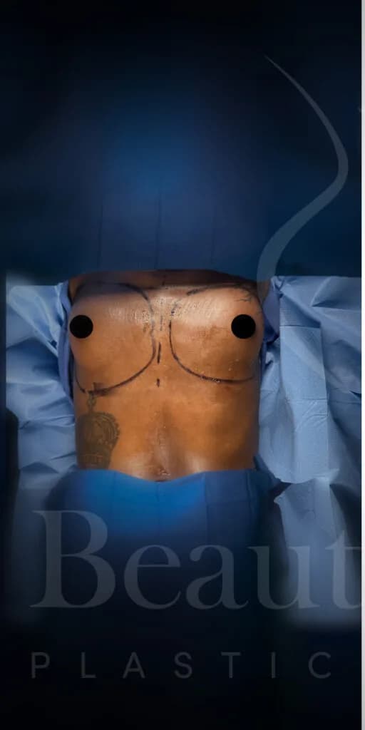 Aumento de senos antes por Dr. Oliver Simmons en Miami · Beautyland Plastic Surgery