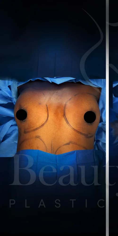 Aumento de senos antes por Dr. Oliver Simmons en Miami · Beautyland Plastic Surgery