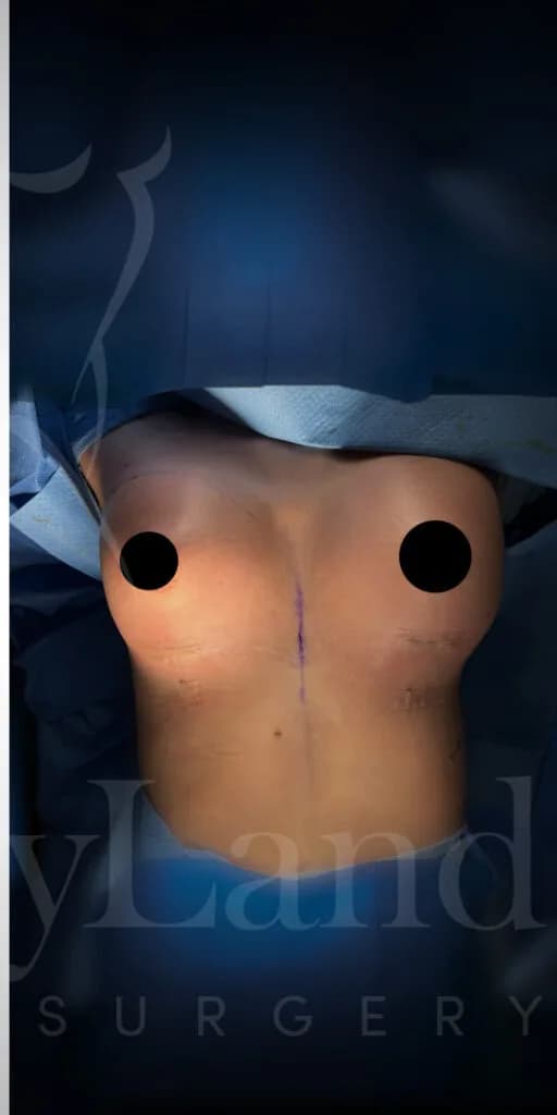 Aumento de senos después por Dr. Oliver Simmons en Miami · Beautyland Plastic Surgery