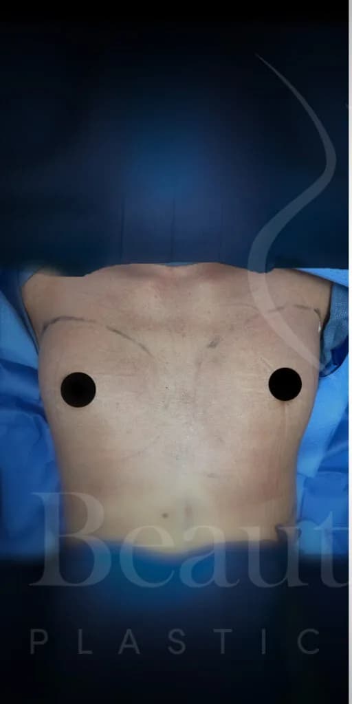 Aumento de senos antes por Dr. Oliver Simmons en Miami · Beautyland Plastic Surgery
