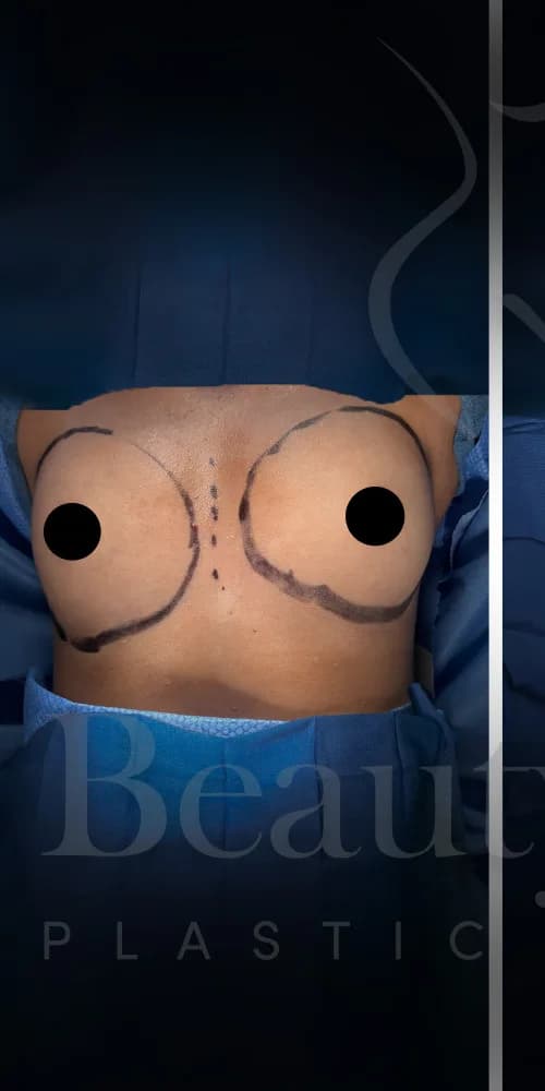 Aumento de senos antes por Dr. Oliver Simmons en Miami · Beautyland Plastic Surgery