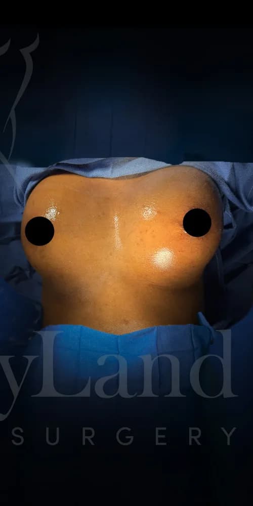 Aumento de senos después por Dr. Oliver Simmons en Miami · Beautyland Plastic Surgery