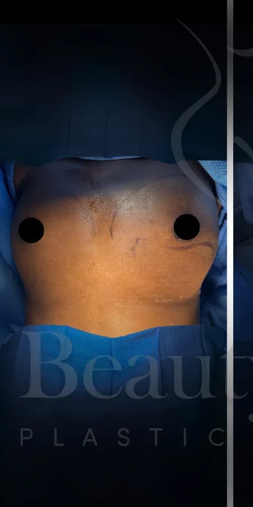 Aumento de senos antes por Dr. Oliver Simmons en Miami · Beautyland Plastic Surgery