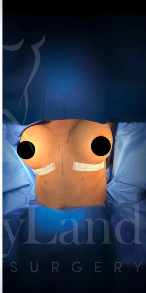 Aumento de senos después por Dr. Oliver Simmons en Miami · Beautyland Plastic Surgery