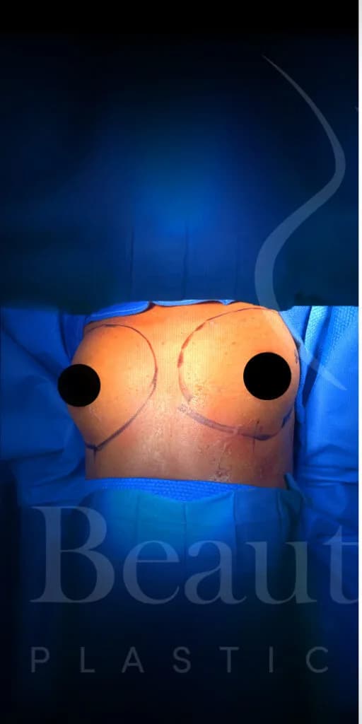 Aumento de senos antes por Dr. Oliver Simmons en Miami · Beautyland Plastic Surgery